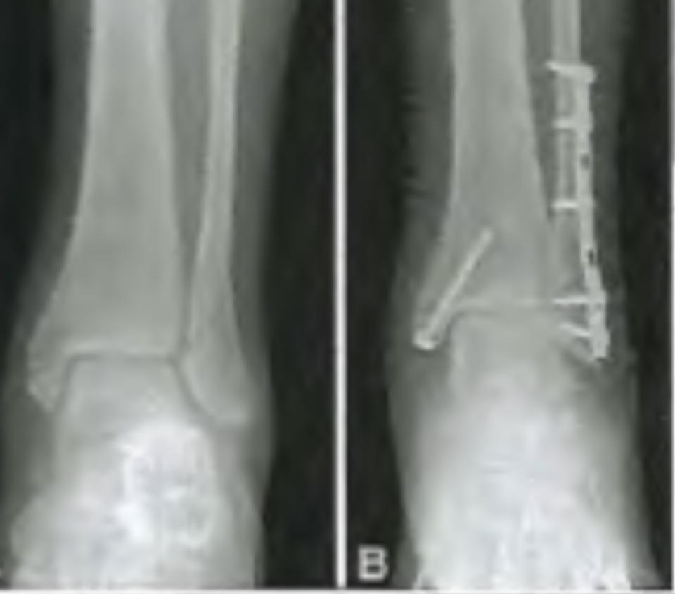 Examples Ankle Surgery