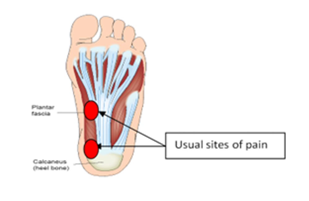 Plantar Fascitis