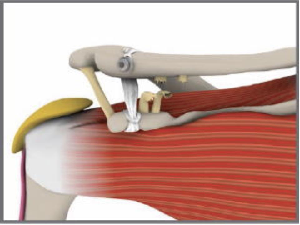 Acromio Clavicular Ligament Repair