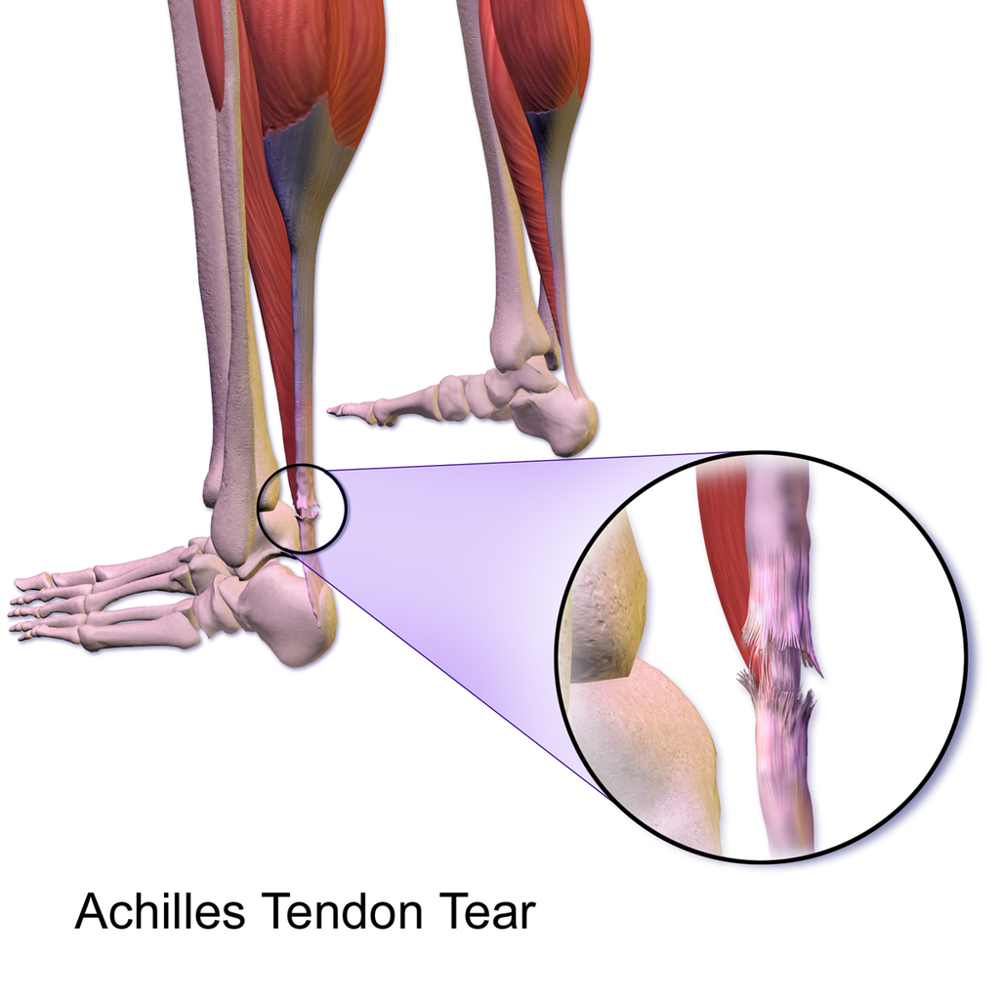 Achilles Rupture Fig 1