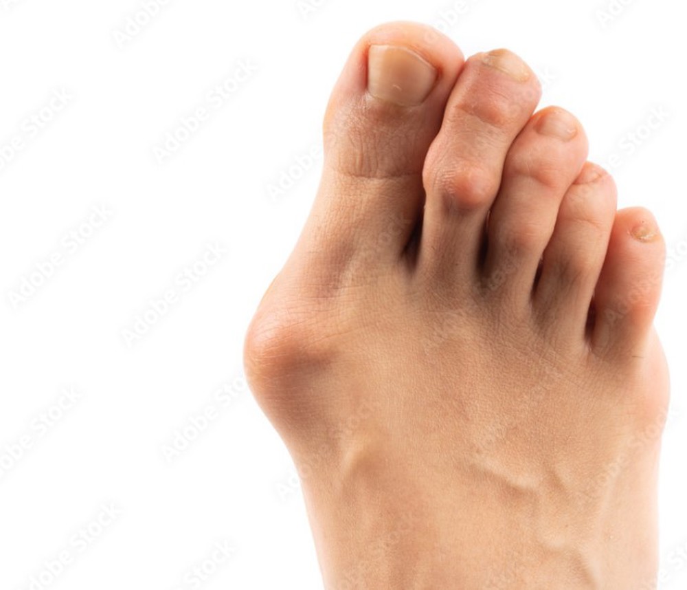 Stock Bunion