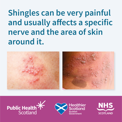 Shingles Vaccine (Static 1A) Sept 2024