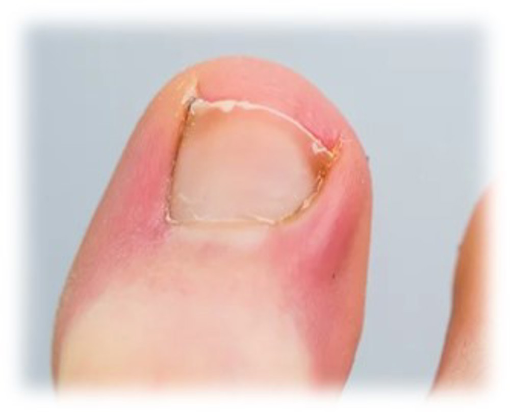 Ingrown Toenail 2