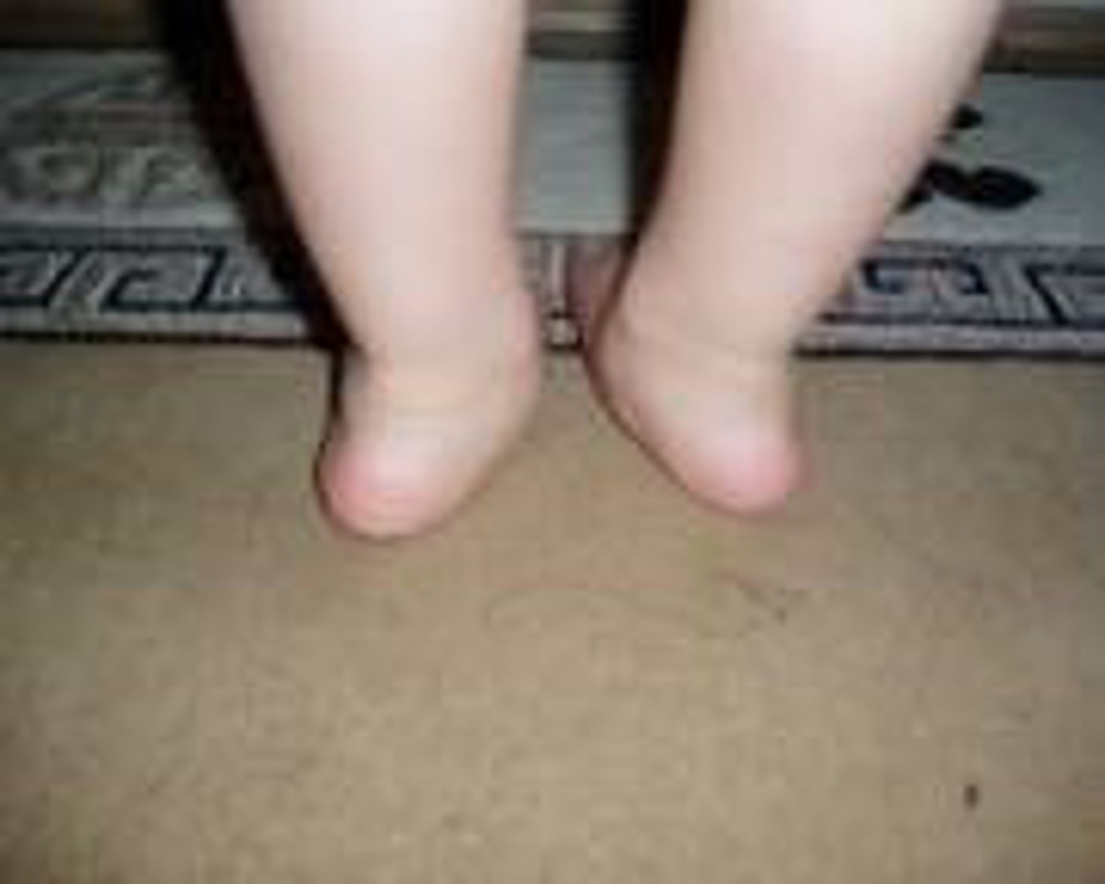 Flat Feet Of A Two Year Old 1