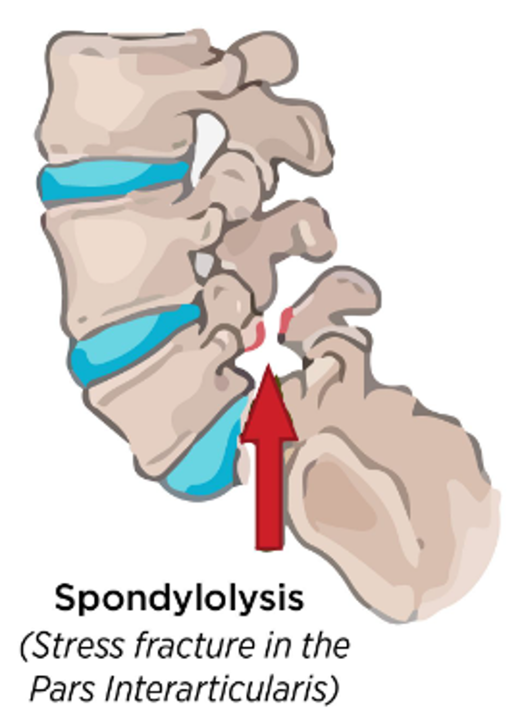 Spondylolysis of the spine