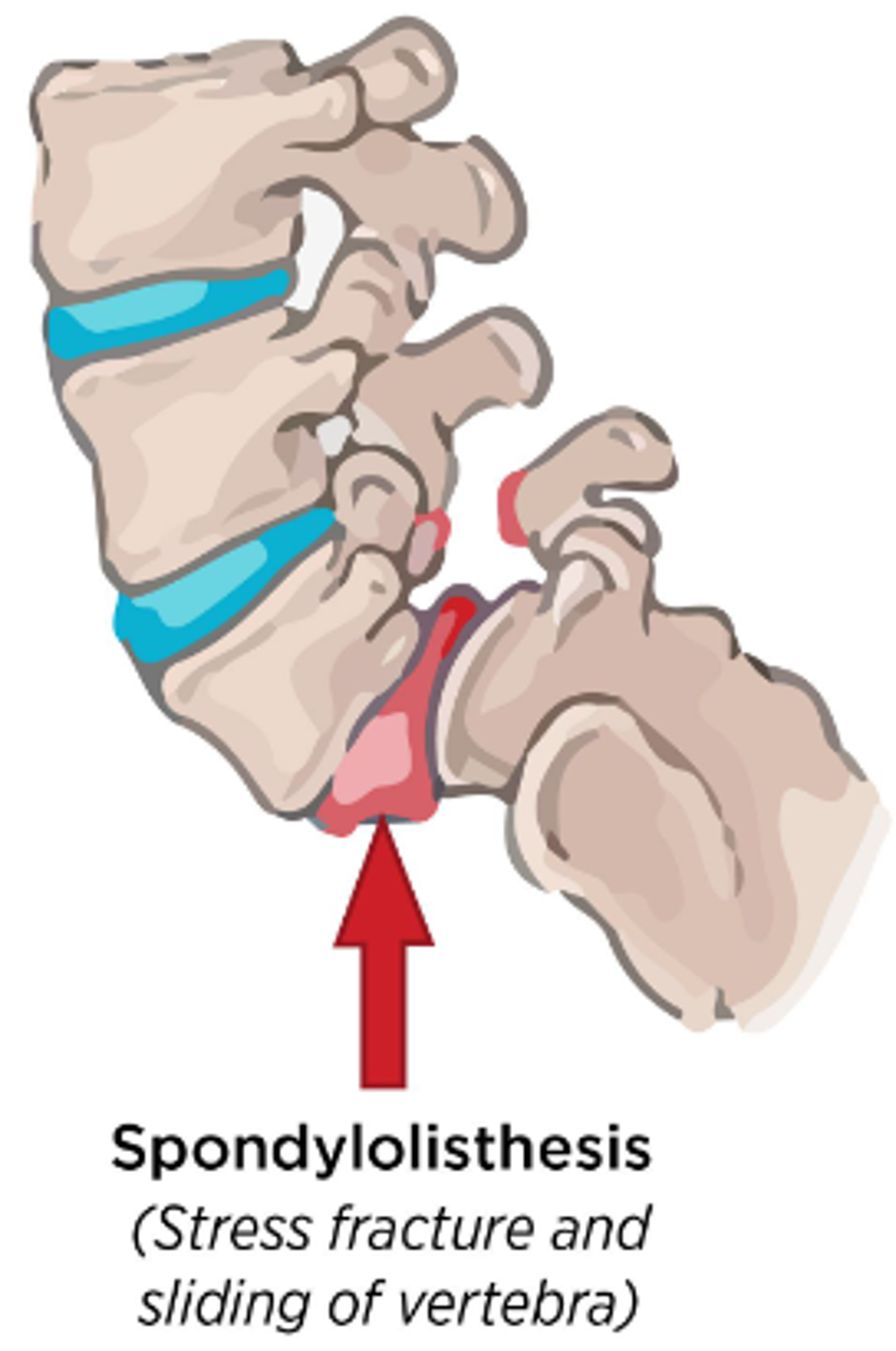 Spondylolisthesis of the spine