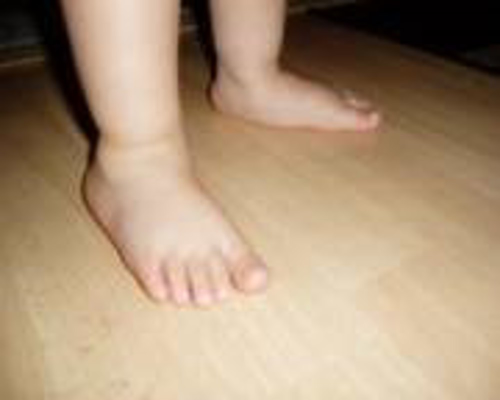 Flat Feet Of A Two Year Old 2